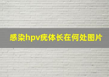 感染hpv疣体长在何处图片